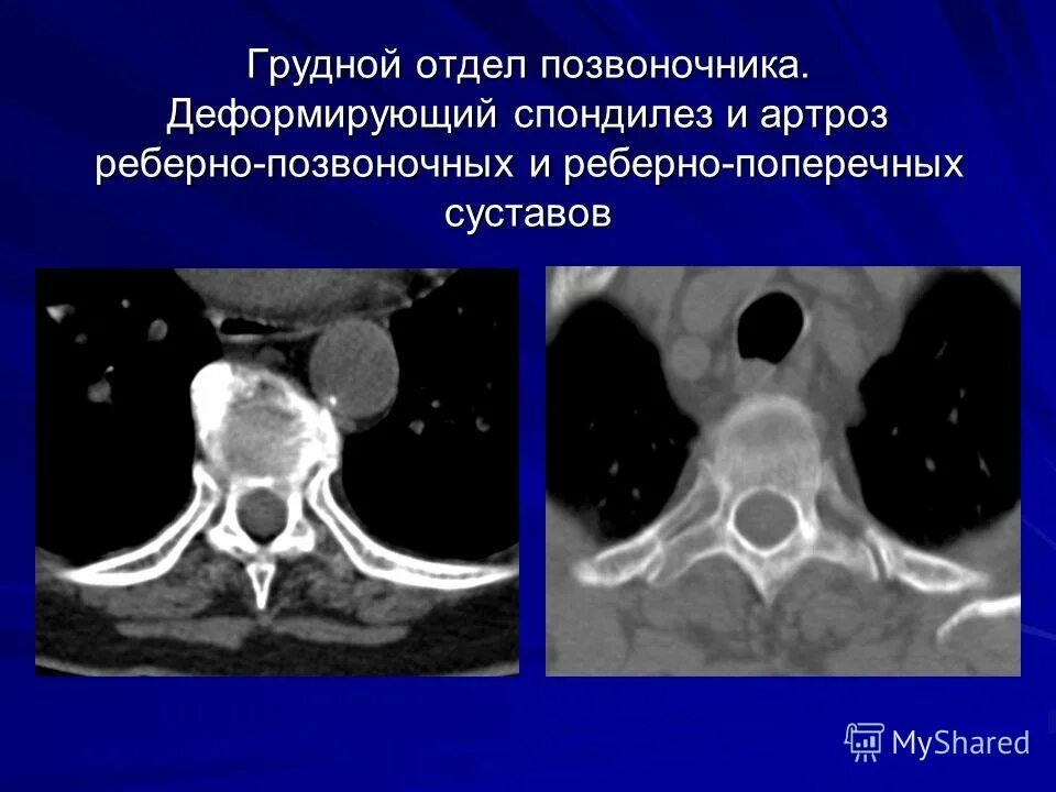 артроз грудного отдела позвоночника симптомы. спондилоартроз пояснично-крестцового отдела. фасеточные межпозвонковые суставы. остеоартроз дугоотросчатых суставов шейного отдела. спондилоартроз пояснично-крестцового отдела.