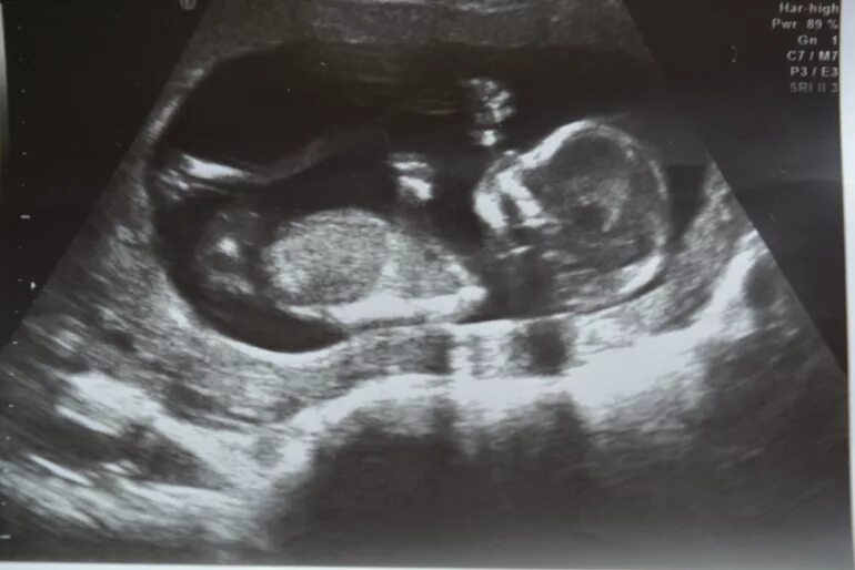 12 недель и 1 день. Скрининг 11 недель беременности мальчик. УЗИ 12 недель беременности. УЗИ малыша на 12 неделе. УЗИ 13 недель беременности скрининговое.