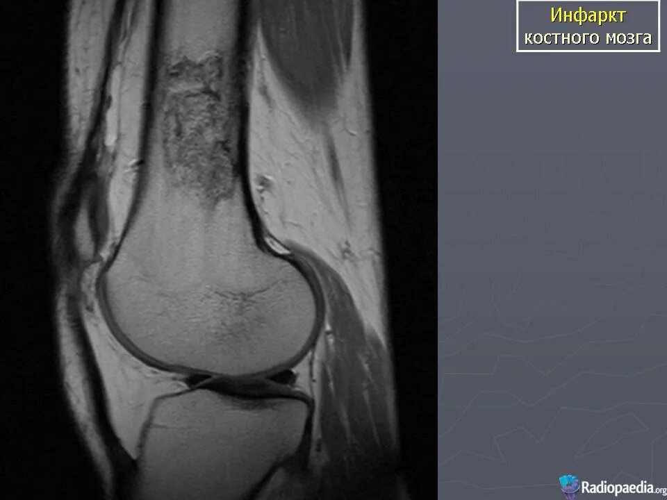 Инфаркт костного мозга коленного сустава рентген. Инфаркт костного мозга большеберцовой кости рентген. Энхондрома бедренной кости мрт. Некроз костного мозга бедренной кости мрт. Участки отека костного мозга