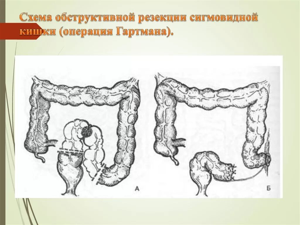 Обструктивная резекция сигмовидной кишки по типу Гартмана. Операция Гартмана при острой кишечной непроходимости. Резекция сигмовидной кишки операция. Слепо ободочная инвагинация.