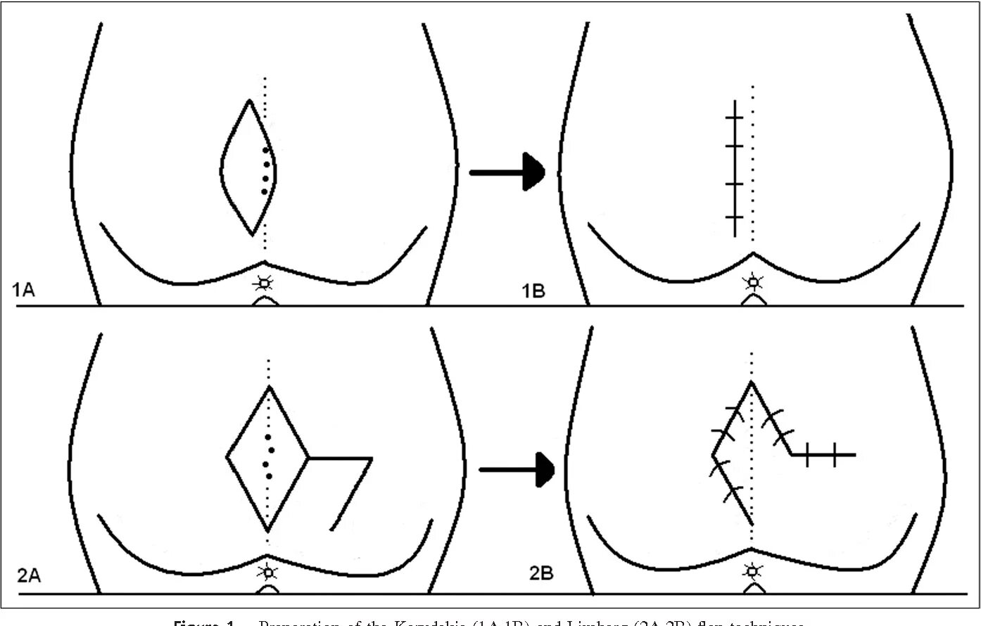 Biodescodificacion - Seno Pilonidal - YouTube