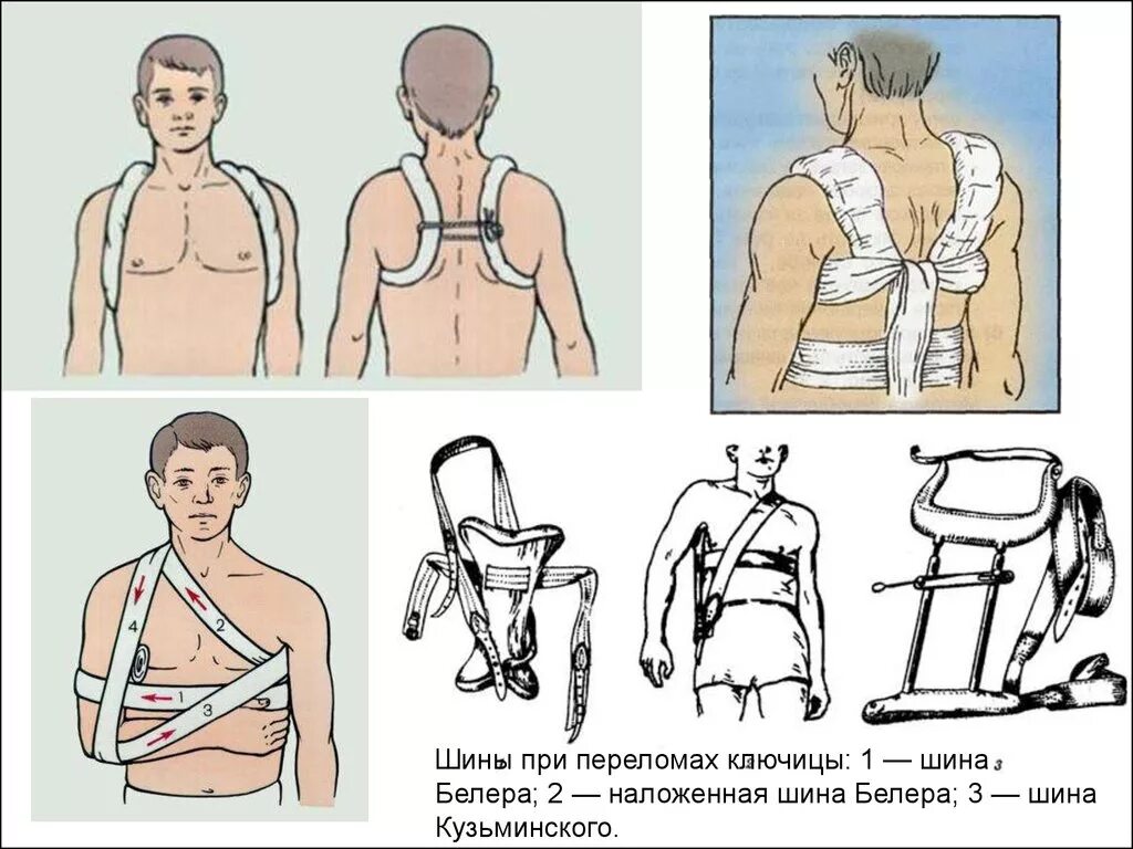 Как оказать помощь при переломе ключицы. Транспортная иммобилизация при переломе ключицы. шина кузьминского при переломе. шина кузьминского для перелома ключицы. транспортная иммобилизация перелома ключицы кольцами дельбе.