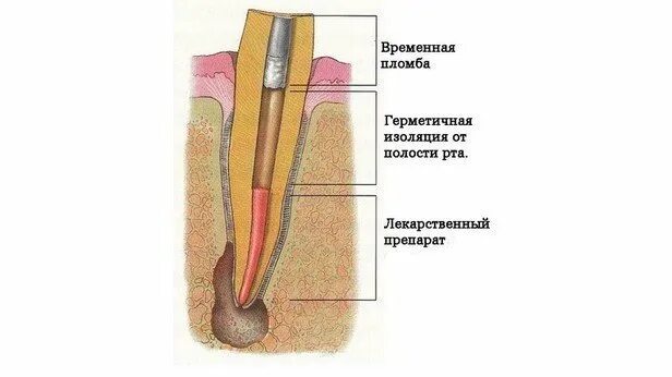 Сколько ходят с лекарством в зубе