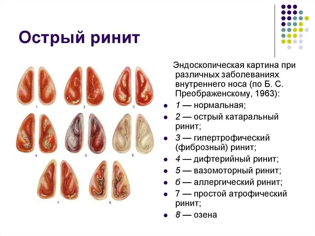 Хронический ринит симптомы у взрослых. Гипертрофический ринит риноскопия. вазомоторный ринит риноскопия. хронический катаральный ринит этиология. катаральный ринит риноскопия.