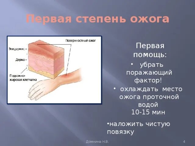 Ожоги 1 степень 2 степень 3 степень 4 степень. Ожог кожи первой степени. Ожог горячей водой в домашних условиях