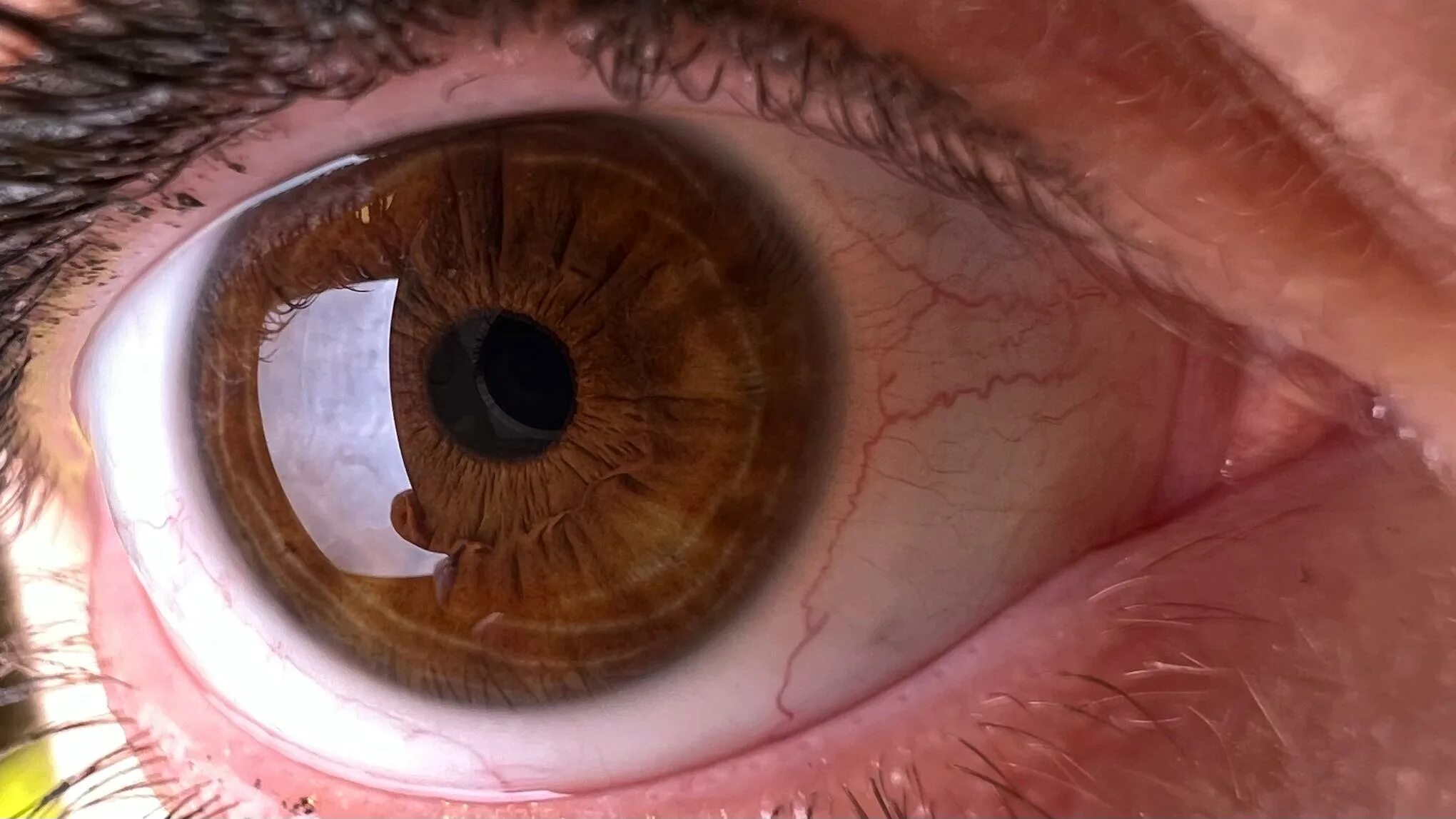 EyePhone: How one doctor is using the iPhone 13 Pro's macro capabilities to remo