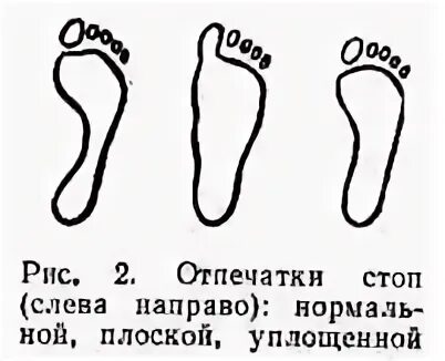 Здоровая стопа. Ступня сбоку. Акупунктурные точки стопы схема. Плоскостопие вальгусная деформация. Болят стопы ног кость сбоку.