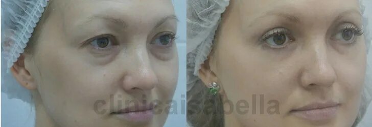 Блефаропластика делается под наркозом. Константа вологда блефаропластика. блефаропластика под наркозом. блефаропластика вологда глазная больница. блефаропластика анестезия.