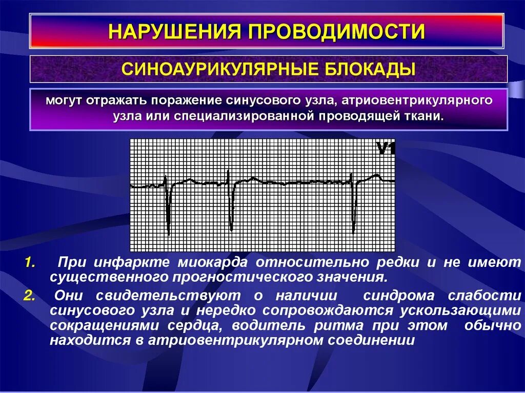 Блокада узла. Синдромы нарушений проводимости ЭКГ. Формы нарушения проводимости миокарда. Нарушение сердечной проводимости. Нарушение функции проводимости сердца.