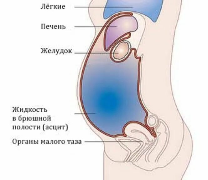 Мужчины жидкость в тазу. Асцит накопления жидкости. Жидкость в брюшной полости (асцит). Симптомы асцита брюшной полости.