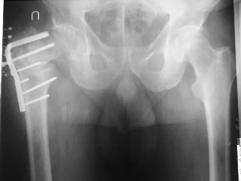 Трещина тазобедренного. Чрезвертельный перелом шейки бедра рентген. Чрезвертельный перелом бедренной кости со смещением рентген. Чрезвертельный перелом бедренной кости рентген. Перелом бедренной кости со смещением рентген.