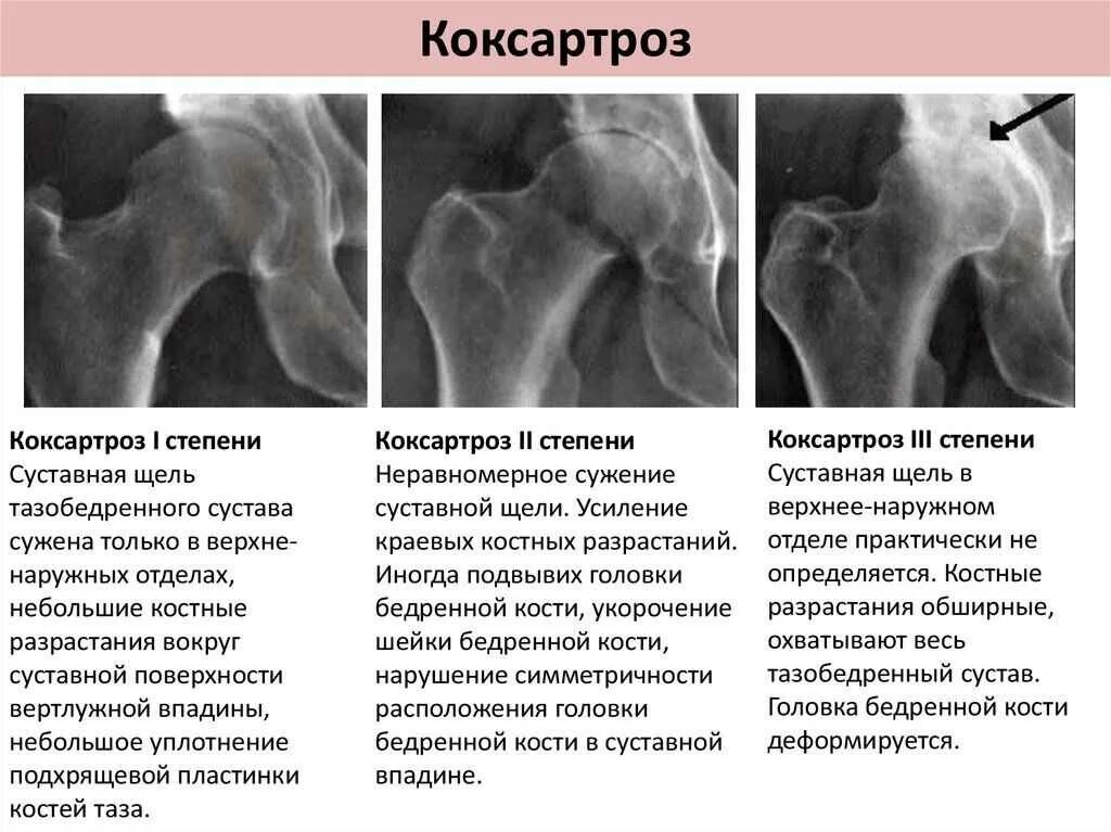 Тазобедренный сустав 3 степени лечение. Диспластический коксартроз рен. коксартроз рентген стадии. деформирующий артроз тазобедренного сустава рентген степени. артроз тазобедренного сустава рентген стадии.
