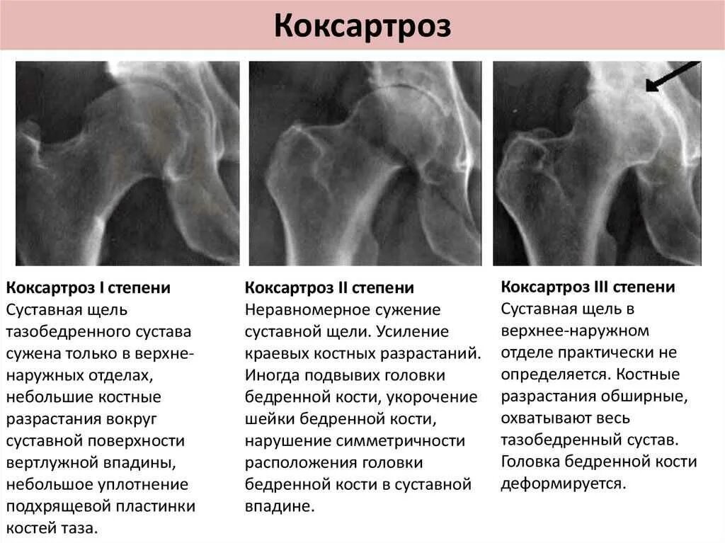 Коксартроз тазобедренного 1 степени у женщин лечение. Диспластический коксартроз РЕН. Коксартроз рентген стадии. Деформирующий артроз тазобедренного сустава рентген степени. Артроз тазобедренного сустава рентген стадии.