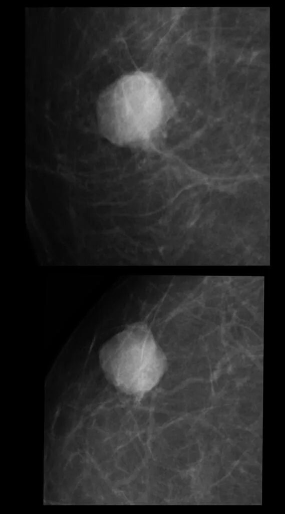 Фиброаденома молочной железы маммография. Маммография рентген молочной железы. Асимметрия плотности молочной железы. Радиальный рубец сэмба на маммографии. Асимметрия плотности молочной железы.