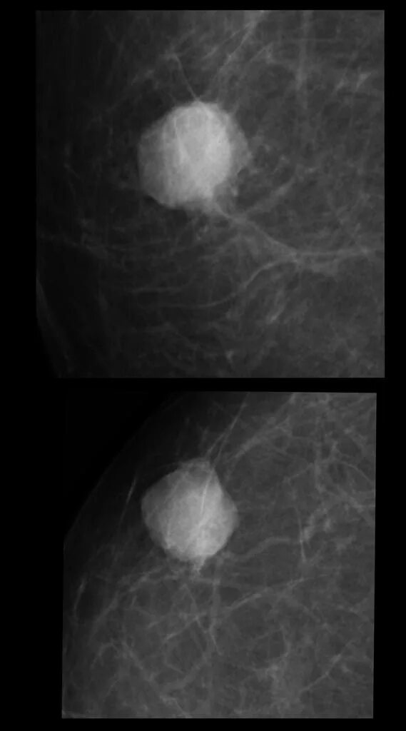 Маммография молочных желез 4. Маммография фиброаденома. Диффузный фиброаденоматоз. Фиброаденома молочной железы рентген. Фиброаденома молочной железы маммография.