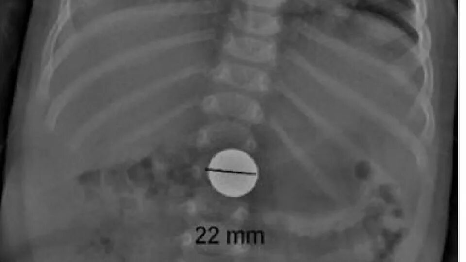 Проглотил через сколько выйдет. Монета в желудке у ребенка на рентгене. Проглоченная монета на рентгене. Монета в кишечнике рентген. Монета в кишечнике у ребенка на рентгене.