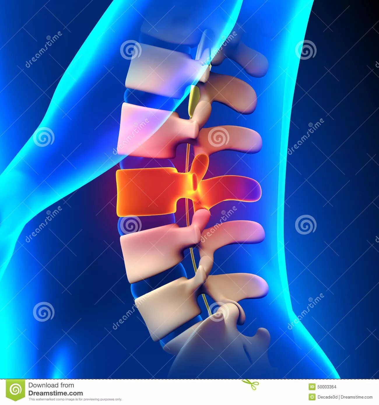 Диски l4-s1. Грыжи межпозвонковых дисков l4-l5 l5-s1. Межпозвонковый диск l4-5. Диски позвоночника l3-4, l5-s1. Диск l 3.