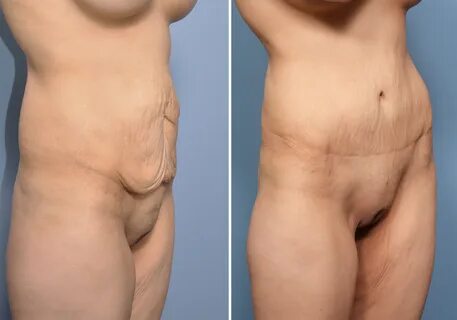 Slideshow tummy tuck bigger dick.