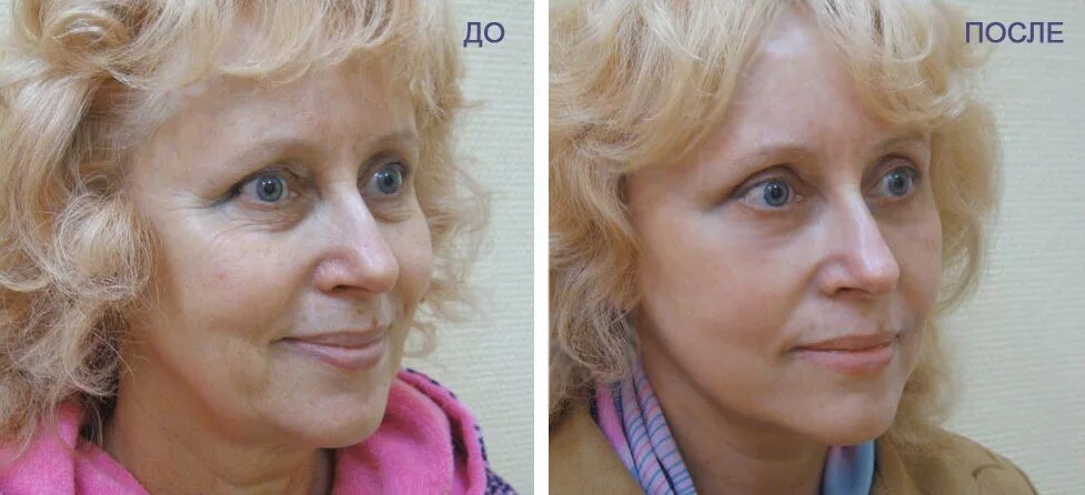 Плазма для лица цена в москве. Плазмолифтинг до и после. Плазмотерапия лица фото до и после. До и после плазмолифтинга лица. Плазма лифтинг для лица до и после.