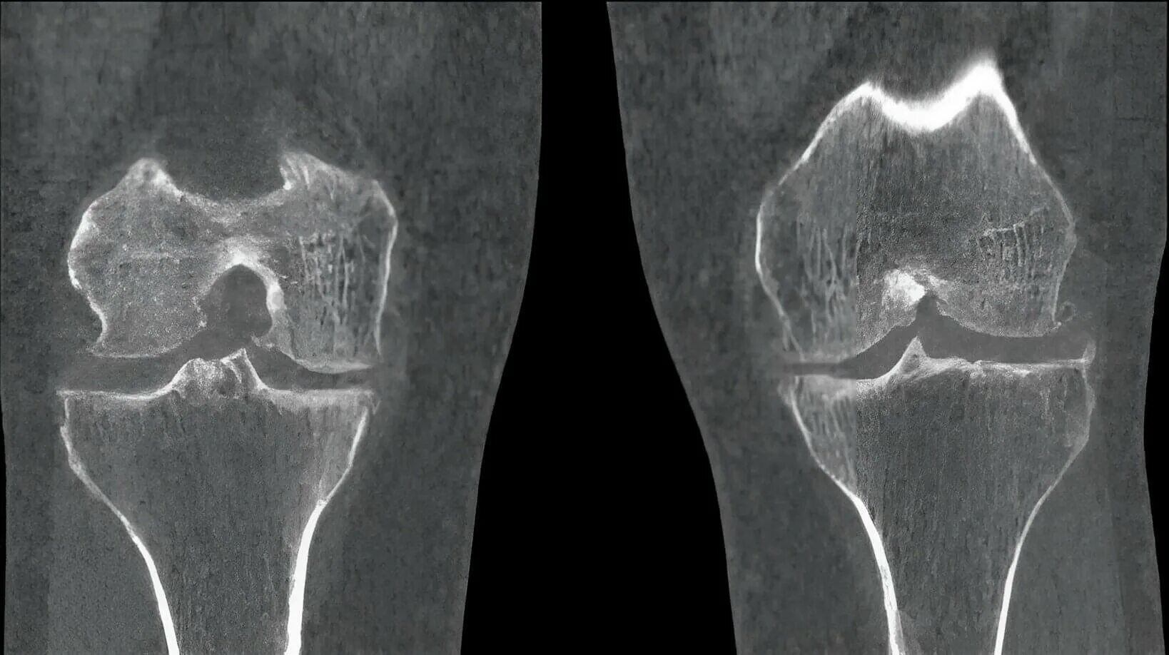 Артрит кт. Гонартроз коленного сустава рентген. Гонартроз коленного сустава кт. Деформирующий остеоартроз кт.