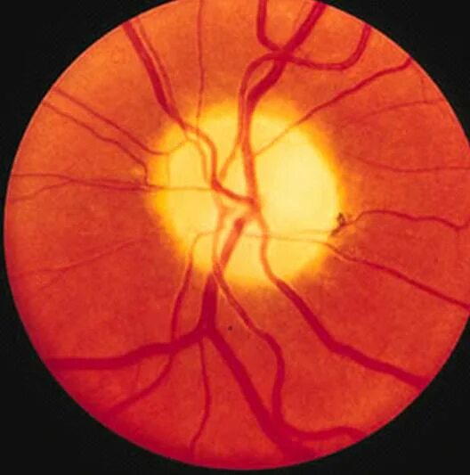 Атрофия зрительного нерва Лебера. Колобома сетчатки глаза. Атрофия зрительного нерва Лебера генетика. Колобома зрительного нерва.