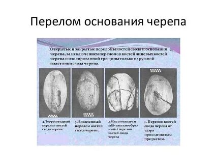 Признаки перелома черепа
