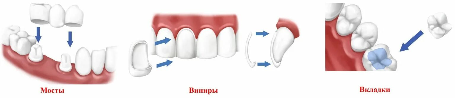 Штифтово культевая конструкция. Керамическая вкладка емакс. Вкладка керамическая (inlay, onlay, overlay, pinlay). Керамические вкладки emax. Композитные вкладки на зубы.