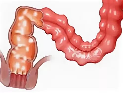 Колика при колите. Спастическая толстая кишка.
