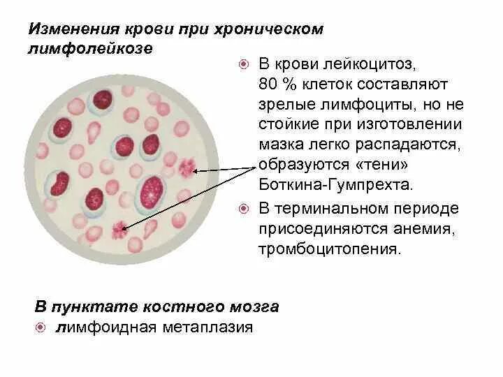 Клетки лейколиза (тени Боткина-Гумпрехта). Тени Боткина Гумпрехта норма. Клетки Боткина Гумпрехта это. Хронический лимфолейкоз клетки Боткина Гумпрехта. Кровь при лимфолейкозе