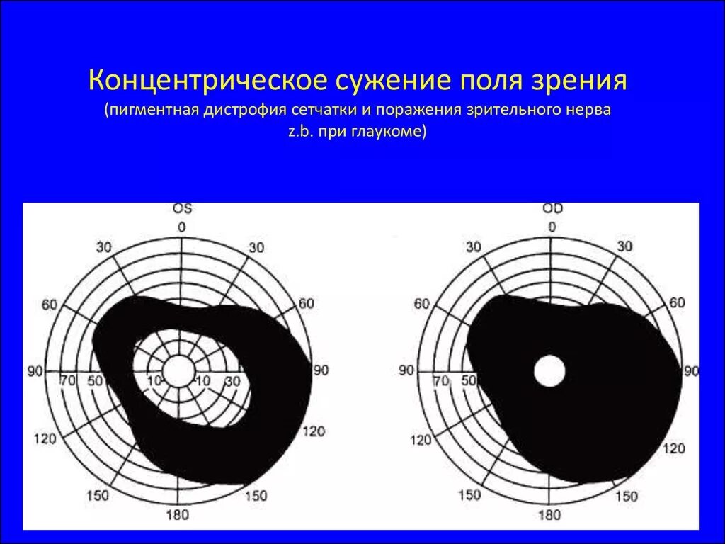 Концентрическое сужение границ поля зрения. Периметрия сужение полей зрения. Сужение поля зрения периметрия глаукома. Поля зрения при дистрофии сетчатки. Монимен