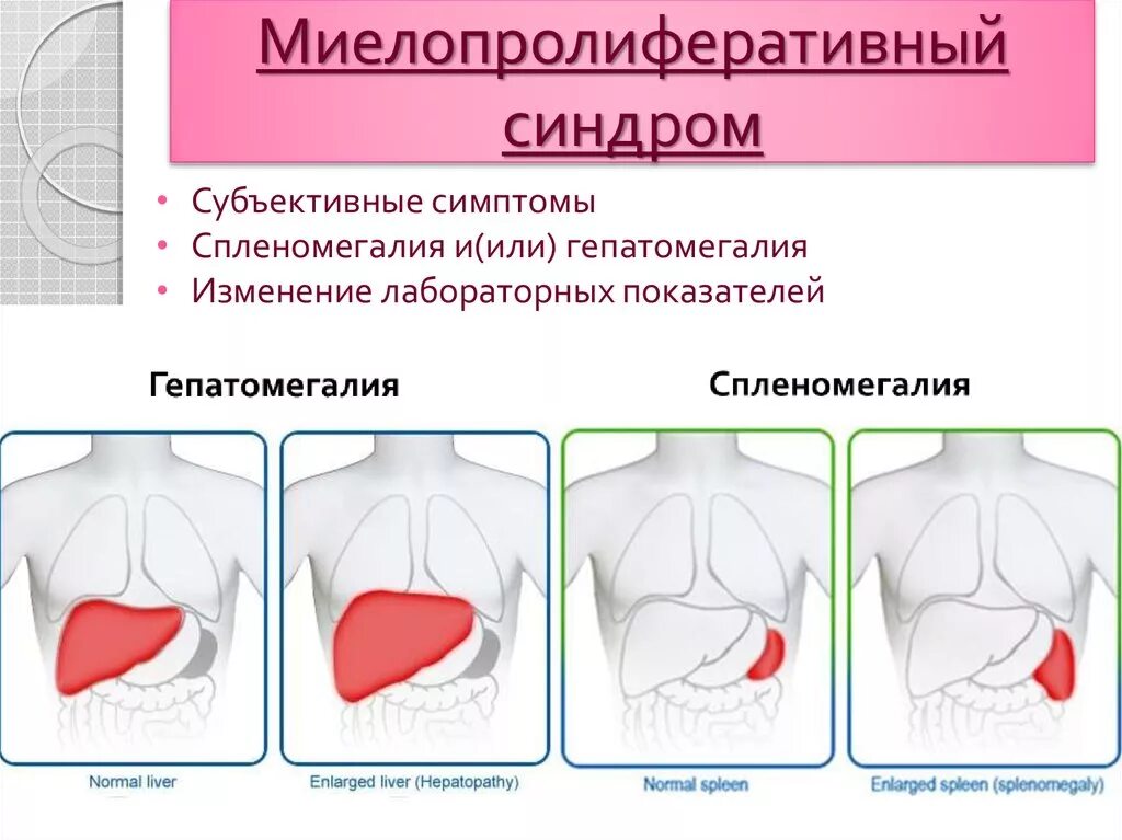 Миелопролиферативный синдром. Симптомы миелопролиферативного синдрома. Спленомегалия патогенез. Гепатомегалия и спленомегалия.