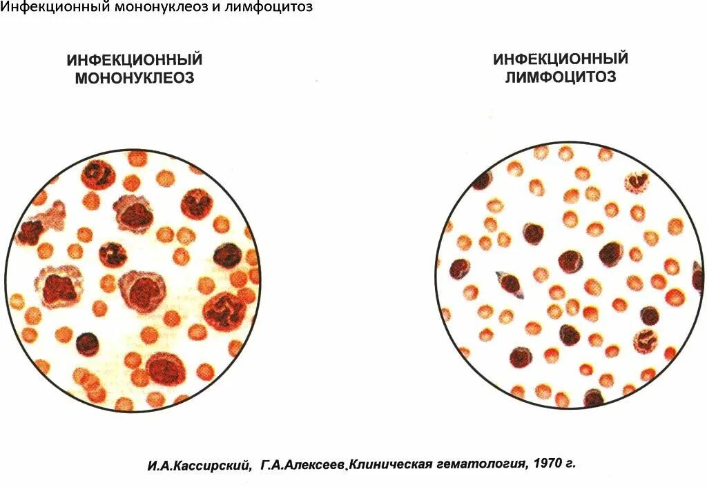 Мононуклеоз это. Картина крови при мононуклеозе. Инфекционный мононуклеоз распространённость. Инфекционный мононуклеоз картина крови. Инфекционный мононуклеоз вакцина.