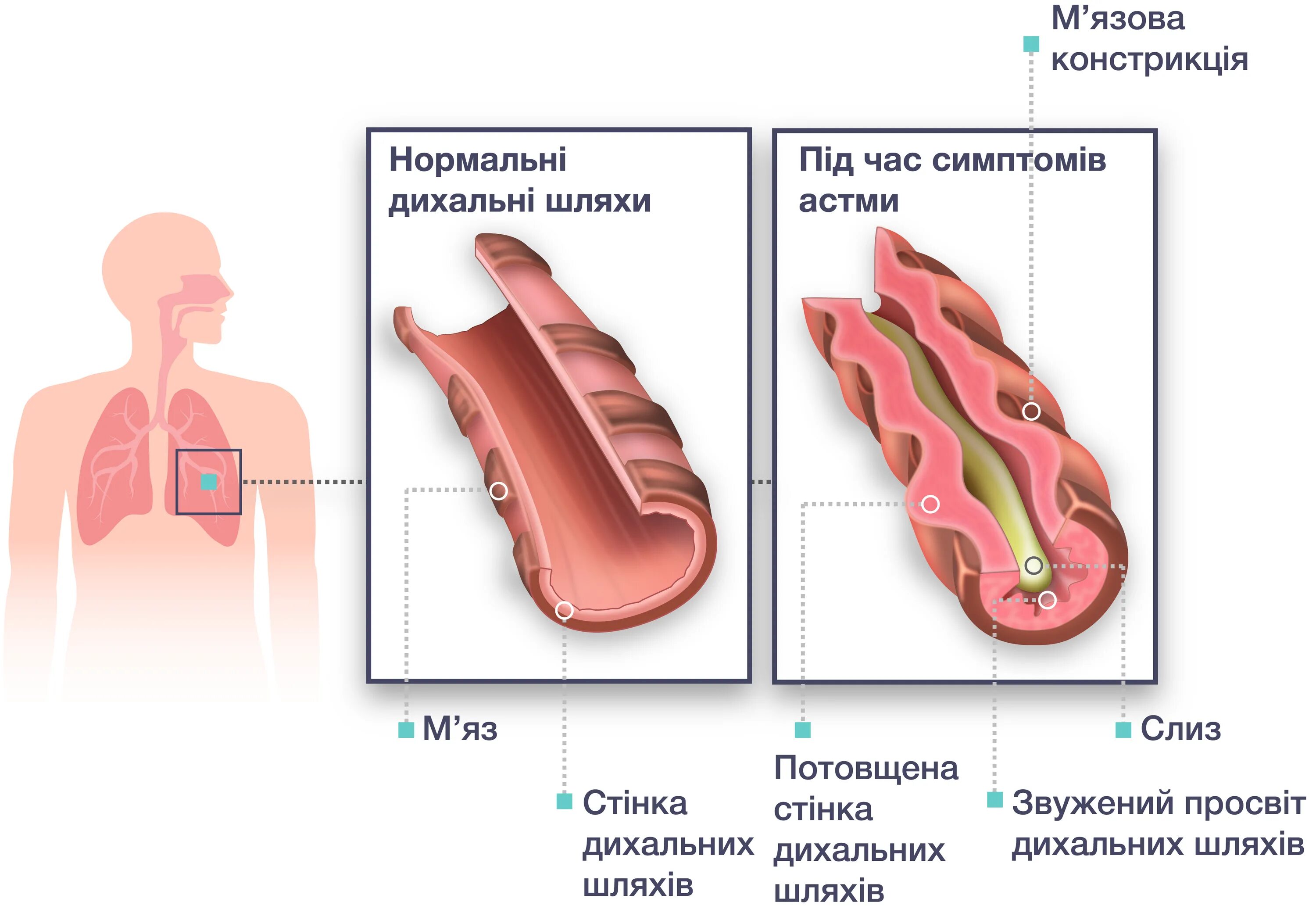 При кашле свист при выдохе. Свистящий кашель. Свистящее дыхание. Ребёнок хрипит при дыхании и кашляет без температуры. Бронхит причины путь передачи симптомы лечение.