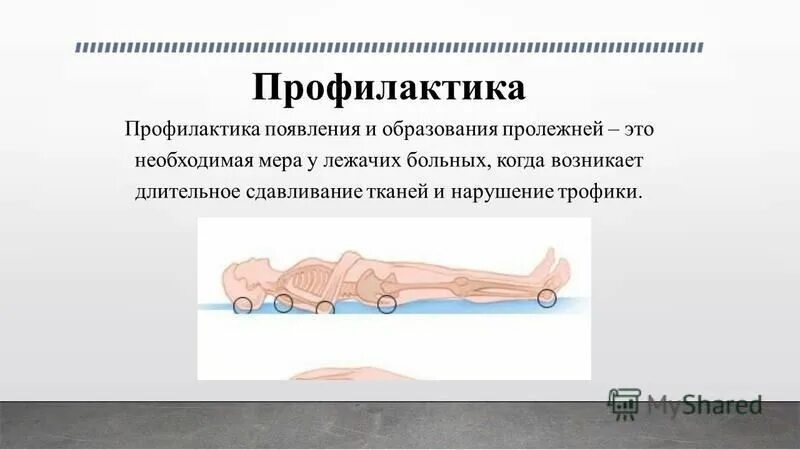 Чтобы не было пролежней у лежачего. Профилактика при пролежнях. предупреждение пролежней. предупреждение образования пролежней. типичные места образования пролежней.