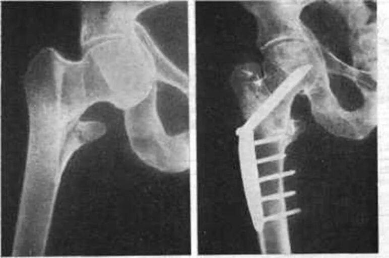 Трещина тазобедренного. Перелом шейки бедра остеосинтез рентген. Оскольчатый перелом шейки бедра рентген. Ложный сустав шейки бедренной кости. Шейка бедра перелом остеосинтез.