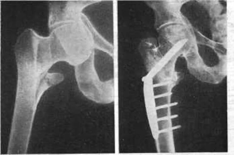 Тазобедренный перелом операция. Перелом шейки бедра остеосинтез рентген. Оскольчатый перелом шейки бедра рентген. Ложный сустав шейки бедренной кости. Шейка бедра перелом остеосинтез.