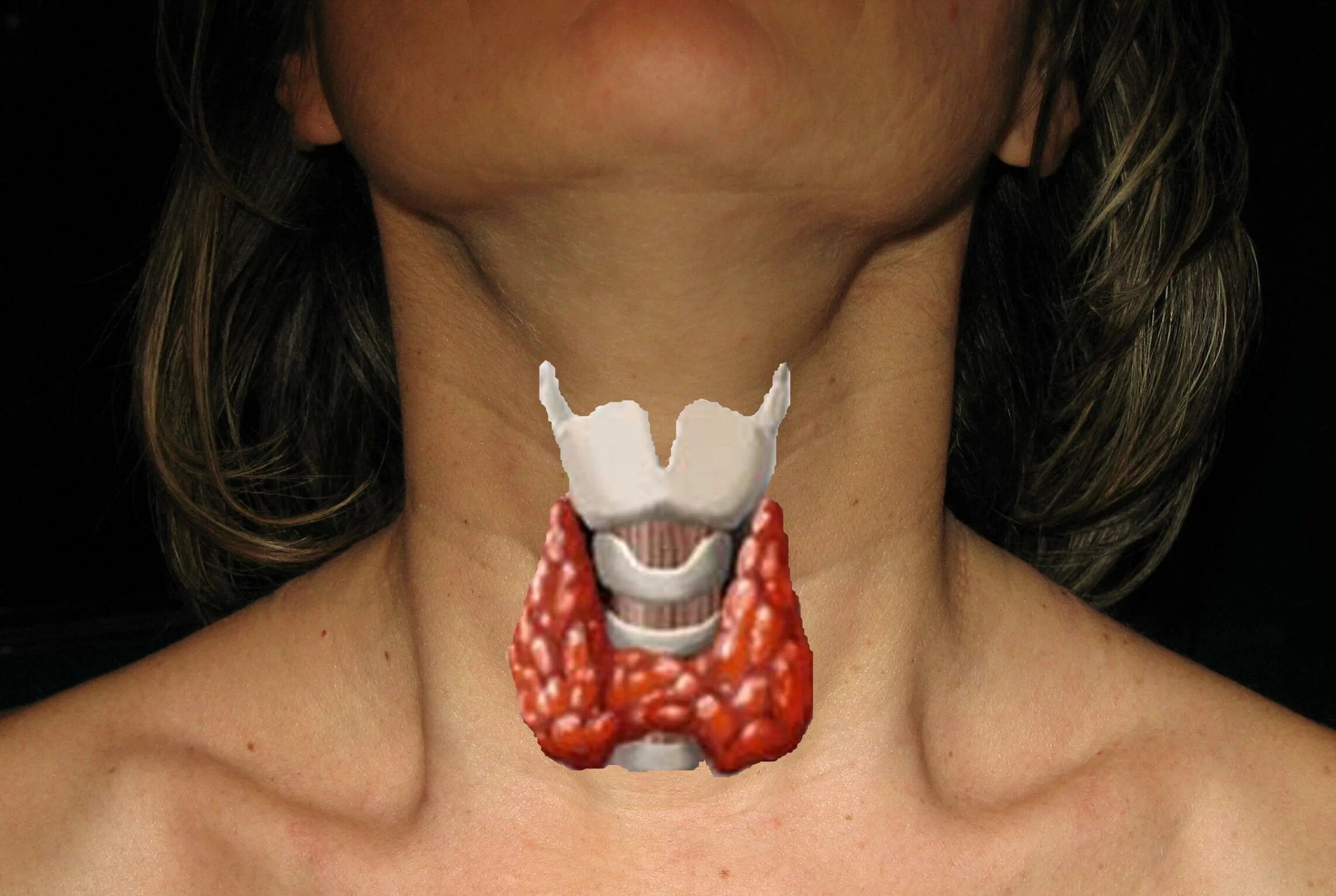Подострый тиреоидит де Кервена. Расширенная щитовидная железа. Увеличенная щитовидная железа зоб.