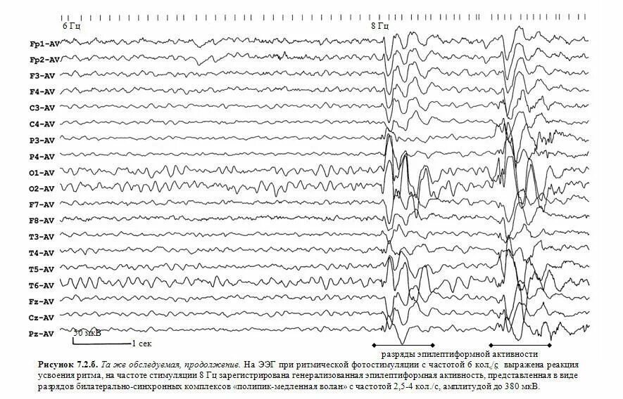 Реакция ээг. Реакция усвоения ритма на ЭЭГ. Ритмическая фотостимуляция при ЭЭГ. Ритмическая фотостимуляция при ЭЭГ норма. Усвоение ритма при фотостимуляции на ЭЭГ.