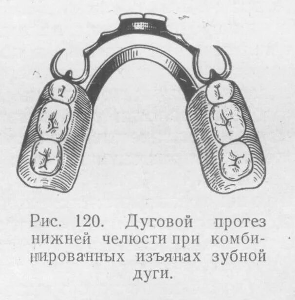 Границы пластиночного протеза. Границы дугового протеза. Дуговой протез на нижнюю челюсть. Границы протеза на нижнюю челюсть.