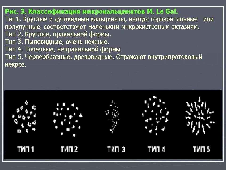 Округлые кальцинаты. Линейные кальцинаты маммография. Кластер микрокальцинатов в молочной железе. Кальцинаты в молочной железе классификация. Типы кальцинатов в молочных железах.