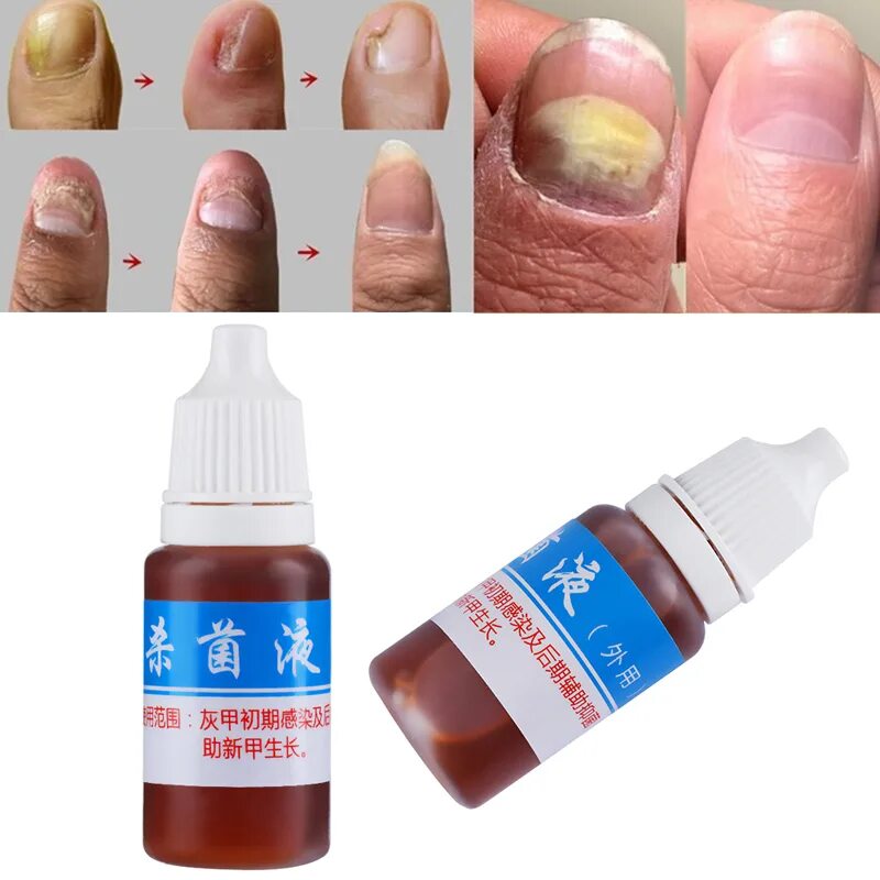 Эффективное лечение грибка ногтей рук. Крем от грибка ногтей Nail fungus. Жидкость от грибка ногтей "Цзяцзясю Чжицзи" (JIAJIAXIUZHIJI/ onychomycosis) Buzhou. Капли на ногтях. Капли от грибка ногтей на руках.