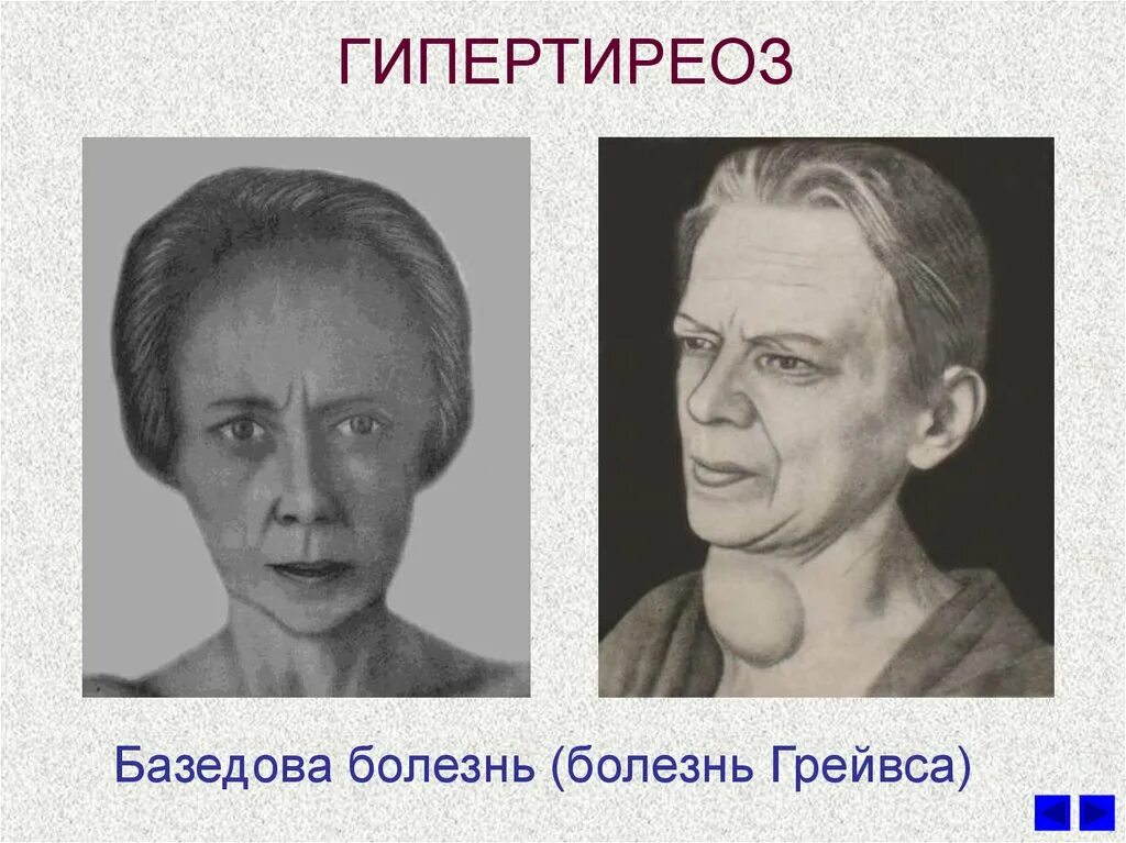 Тиреотоксикоз болезнь грейвса. Болезнь грейвса лабораторная диагностика. Гиперфункция щитовидной железы патогенез. Тиреотоксикоз (базедова болезнь). Болезнь грейвса базедова.