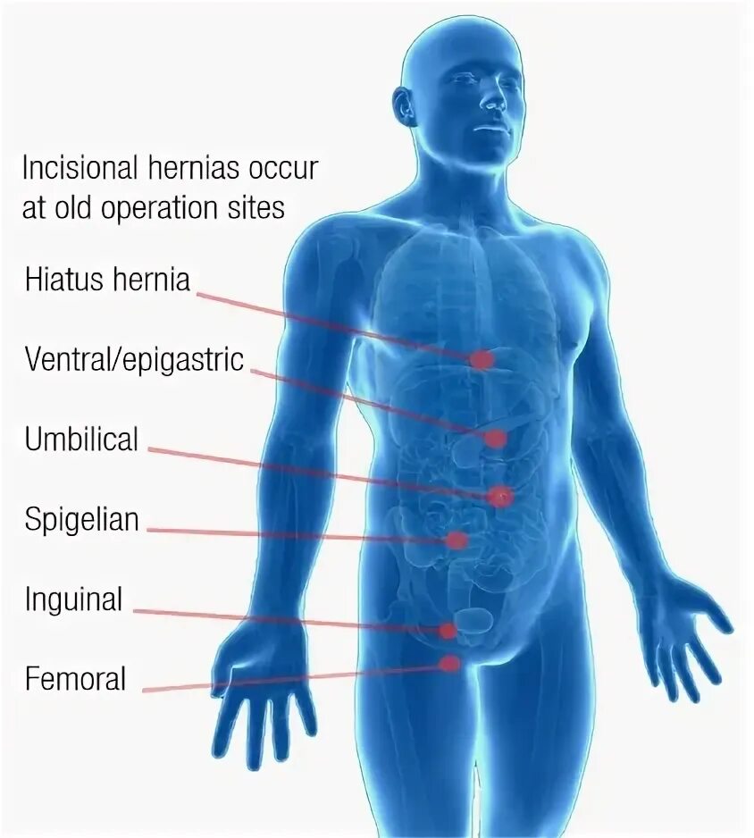 Какие бывают грыжи у человека. Расположение грыж на животе. Какие бывают грыжи у человека. Наружные брюшные грыжи. Какие бывают грыжи у человека.