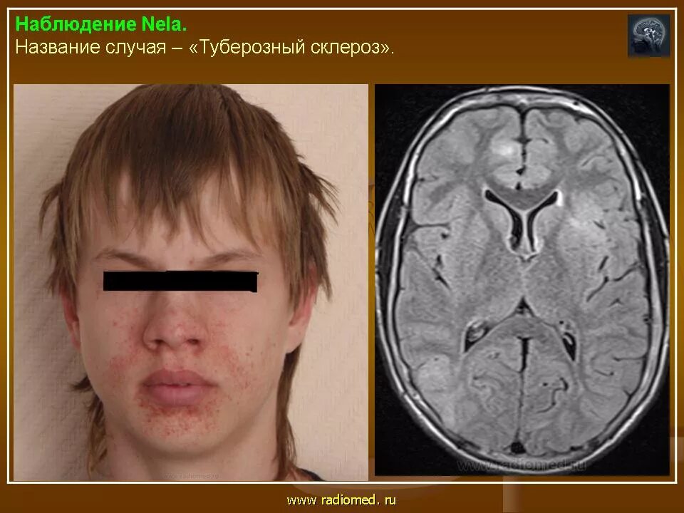 Туберкулезный склероз. Туберкулезный склероз