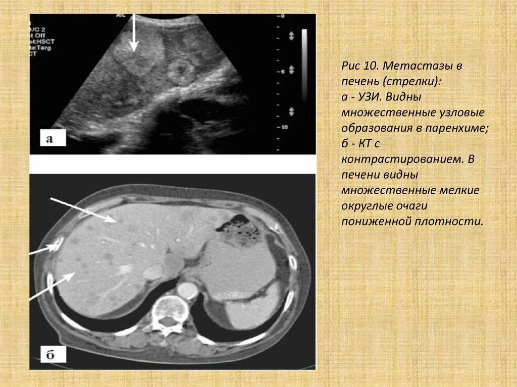 Жировой гепатоз печени на кт с контрастированием. Множественные метастазы печени на кт. Вылечить метастазы в печени