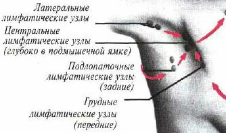 Лимфоузлы под мышками расположение схема. Подмышечные лимфоузлы схема. Где находятся лимфоузлы в подмышках схема. Где подмышками находятся лимфатические узлы. Боли в лимфоузлах подмышками