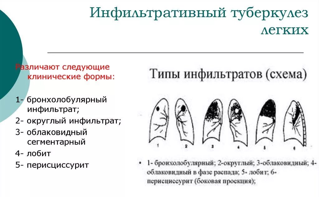 Округлый инфильтрат. Инфильтративный туберкулез легких формы. Инфильтративный туберкулез клинические симптомы. Инфильтративный туберкулез в фазе инфильтрации. Инфильтративный туберкулез классификация.