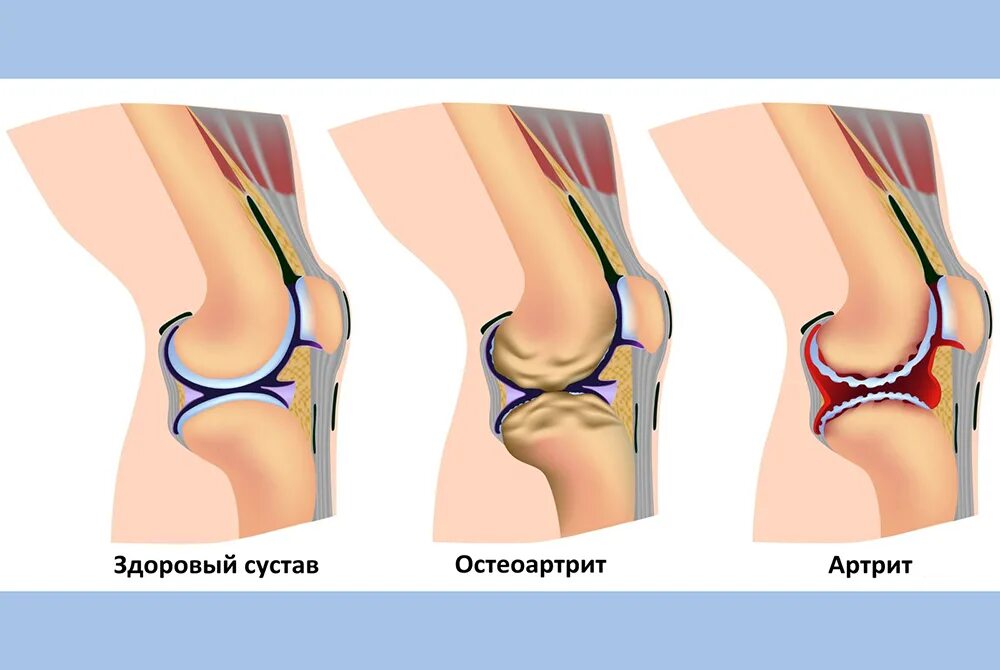 Гонартроз коленного сустава 1. Гонартроза коленного сустава 1. Ревматоидный гонартроз коленного. Первичный гонартроз двусторонний. Типы артритов