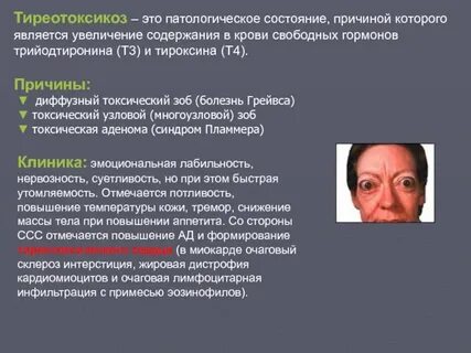 Диффузно токсический зоб тиреотоксикоз