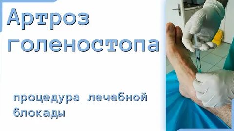 Гиалуроновая кислота в голеностопный